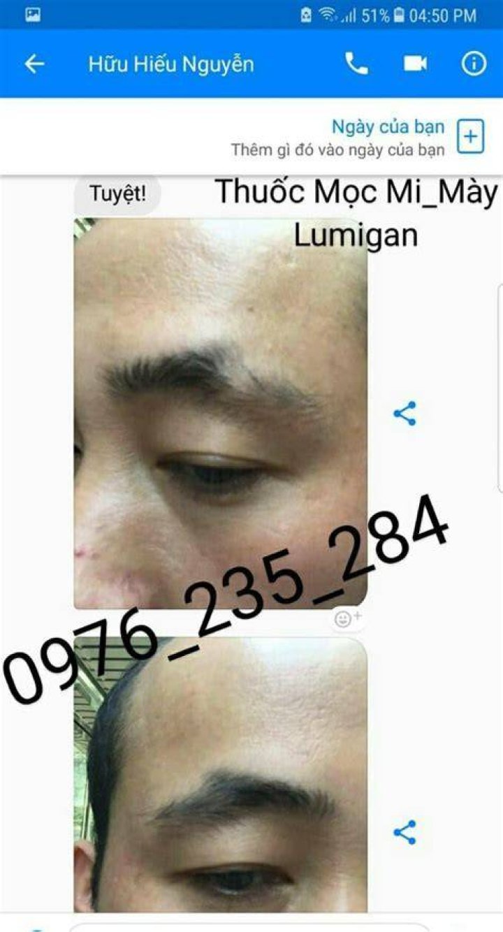 نشرة قطرة لوميجان Lumigan للعين نشرة قطرة لوميجان Lumigan للعين