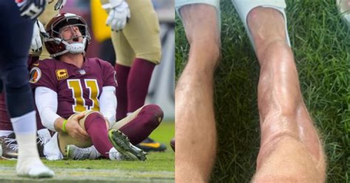 Alex Smith Suffers Horrific Injury 33 Years To The Day After Joe Theismann's Broken Leg