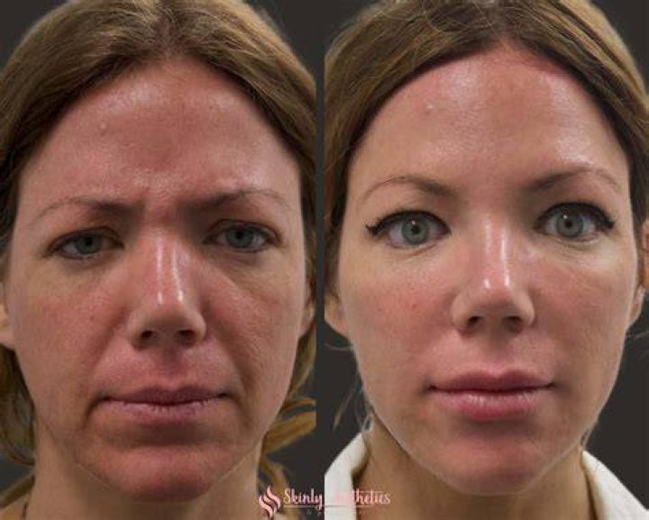 Botched Patient's Illegal Fillers Caused a Hole in Her Face