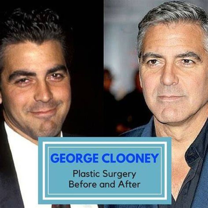 Clooney Plastic Surgery Before and After Celebrity Sizes