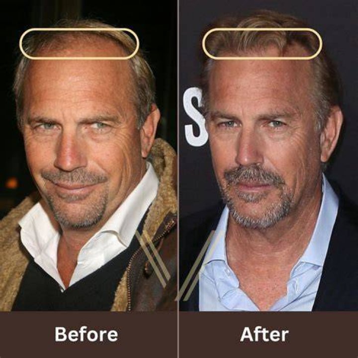 Did Kevin Costner Have Skin Cancer On His Ear? Understanding His Health Journey