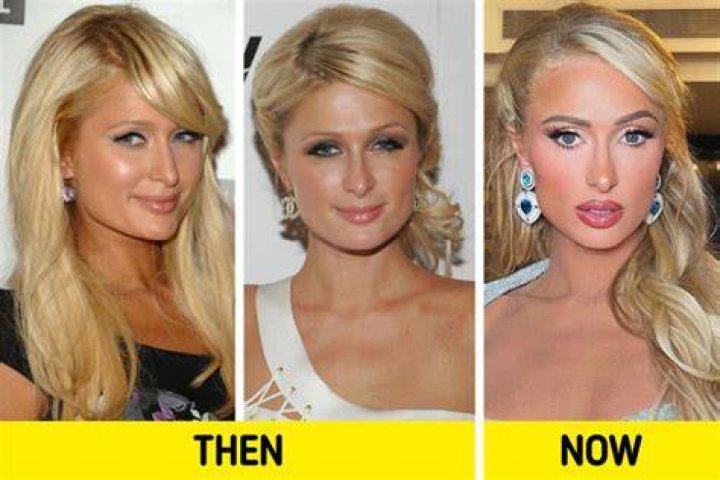 Did Paris Hilton Get Plastic Surgery? The Heiress&rsquo; Quotes about Botox