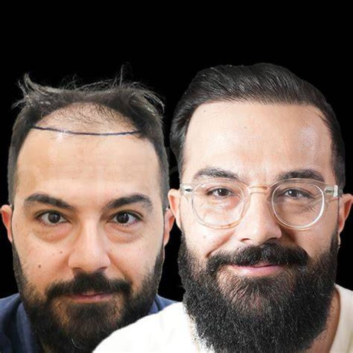 “From 75 to 35”: Man’s Amazing Hair Transformation Goes Viral, SA Speechless