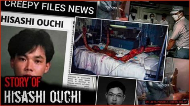 Hisashi Ouchi The Tragic Story Of A Nuclear Accident Victim