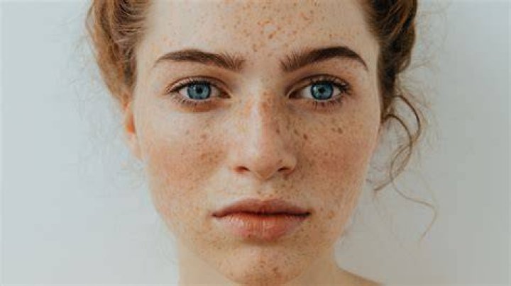 How Freckles Are A Natural Sunscreen