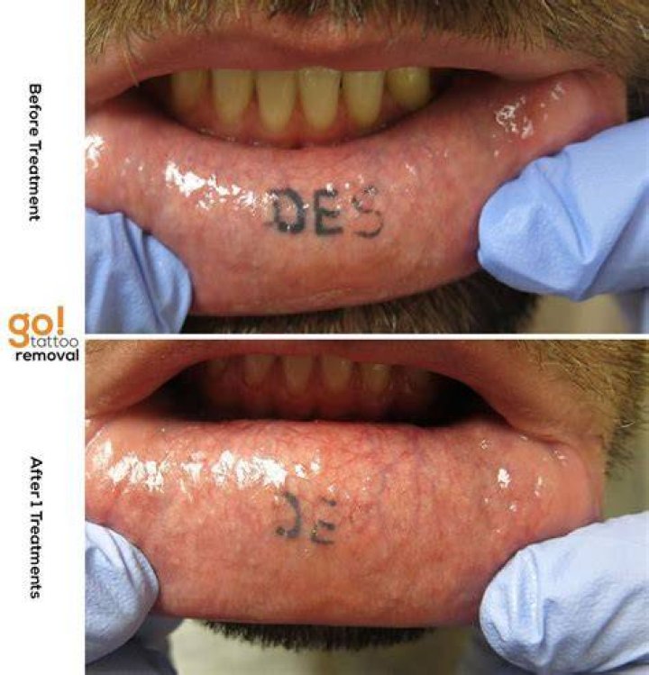 How Long Do Inner Lip Tattoos Last?