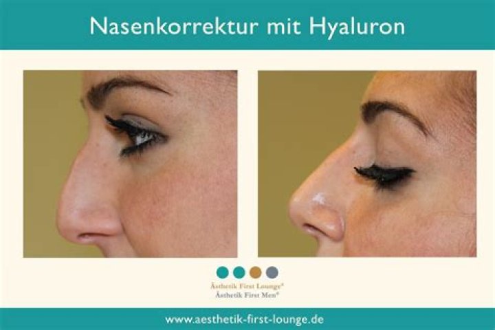 Nasenkorrektur ohne OP Filler/Hyaluron &Auml;sthetik Medical Contour