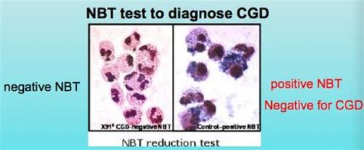NBT test immunology