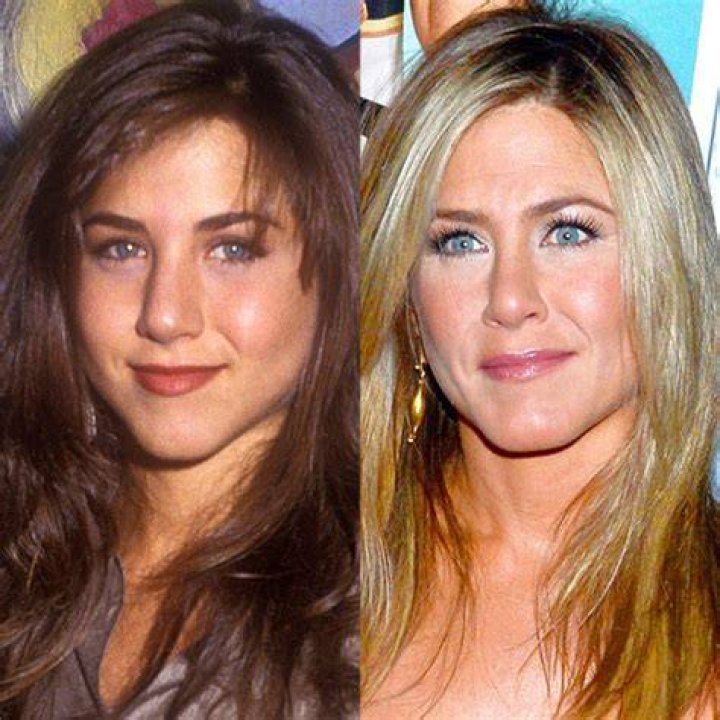 Photos from Celebrities Who Got a Nose Job to Fix Their 