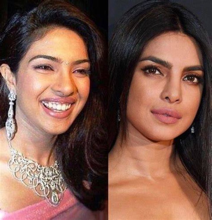 Priyanka Chopra Reveals She Had Surgery to Correct a Botched Nose Job