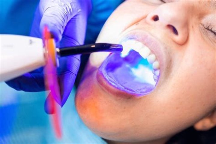 Revolutionizing Dental Care: The Lampara De Fotocurado Apple Dental