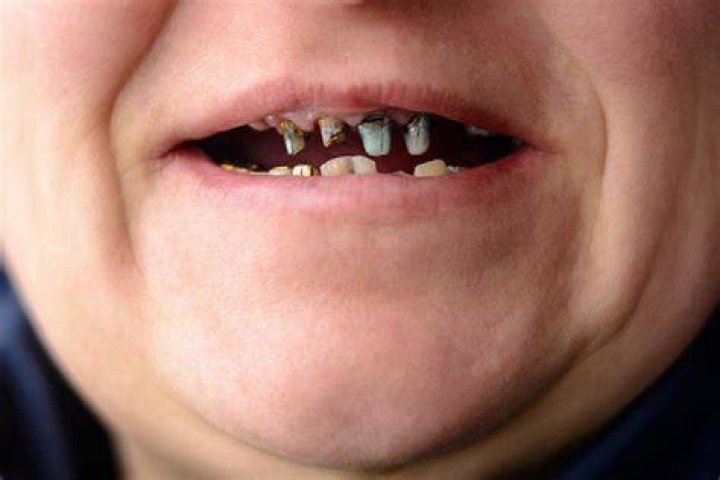 Top 15 Athletes Who Had Really Bad Teeth