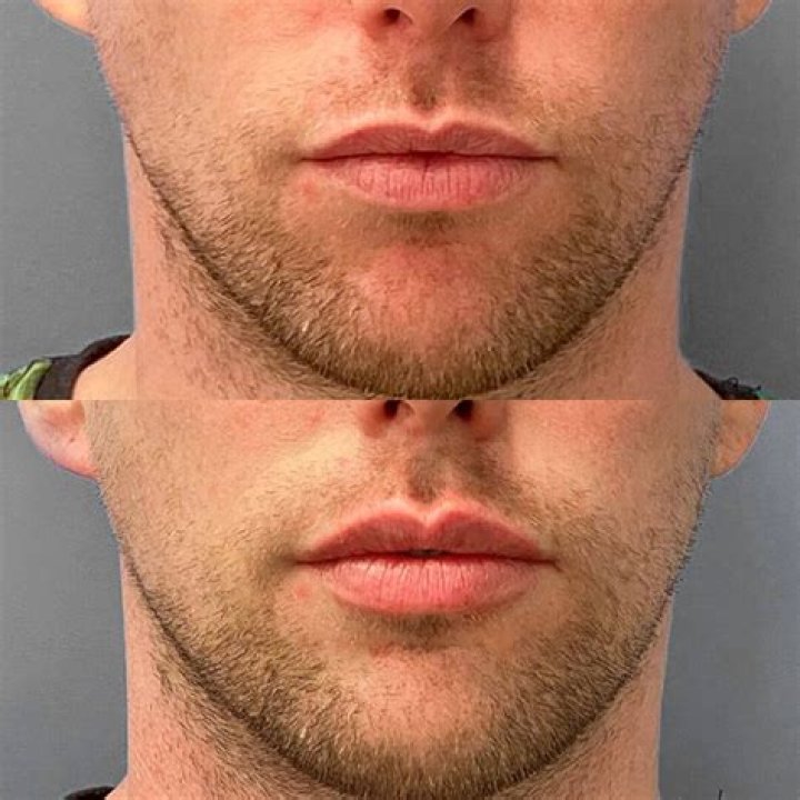 Understanding OP Filler: A Comprehensive Guide To Optimal Aesthetic Treatments