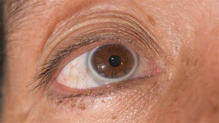 What Does It Mean When You Have A Gray Ring Around Your Cornea?