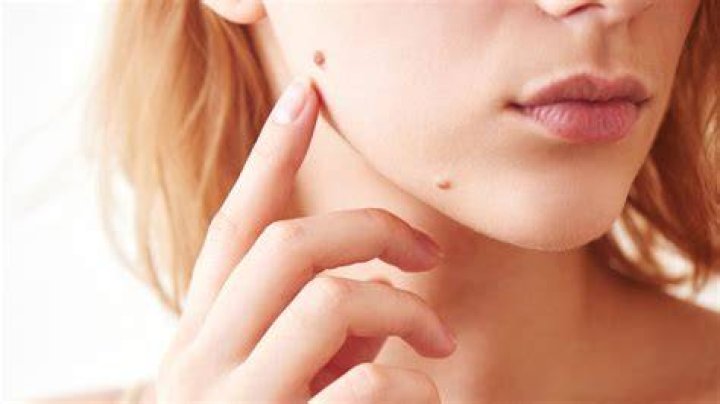 What It Really Means When You Have A Mole On Your Face