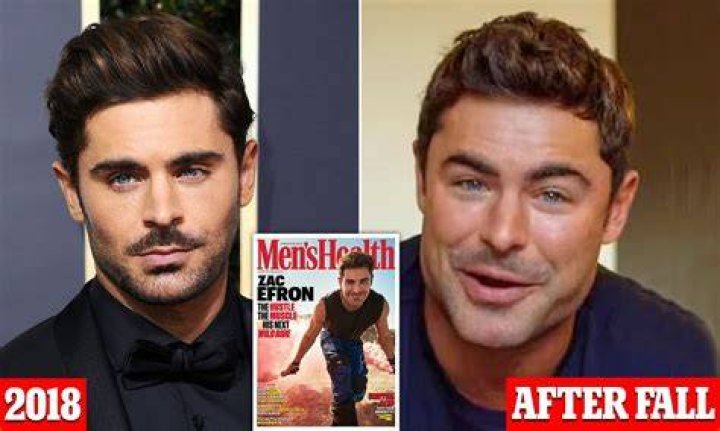 Zac Efron's Face Accident: What Really Happened?